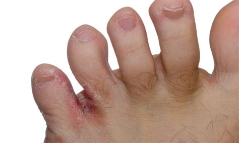 Either toe fungus or toenail fungus or. Athlete's Foot - Dr. Hausen Empire Foot Care