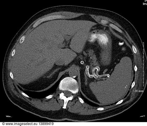 Calcification Of Splenic Artery Calcification Of Splenic Artery Ct