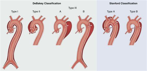 Aneurysms And Dissections Thoracic Key