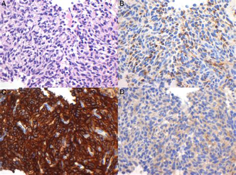 Serial High Power Sections Of Phosphaturic Mesenchymal Tumor From Case