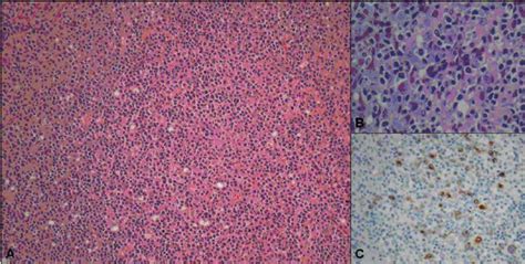 Hiv Lymphadenopathy With Ebv Related Changes A Loss Of Normal Lymph