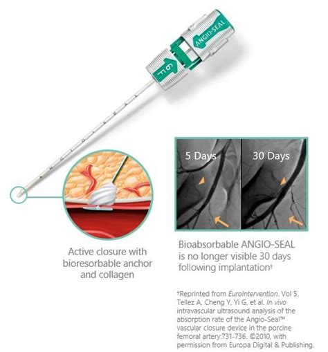 Angio Seal® Vip Vascular Closure Device