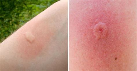 Here Are 8 Common Bug Bites And How You Can Recognize Them