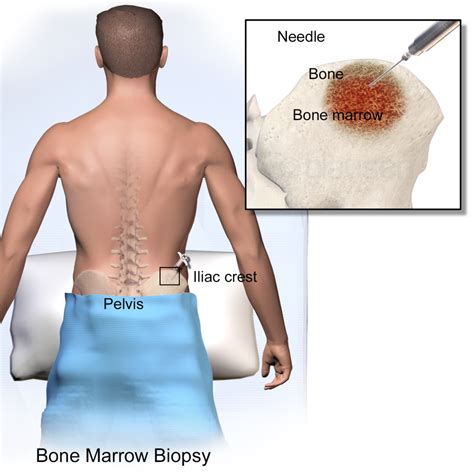 How Painful Is A Bone Marrow Biopsy Can You Be Sedated