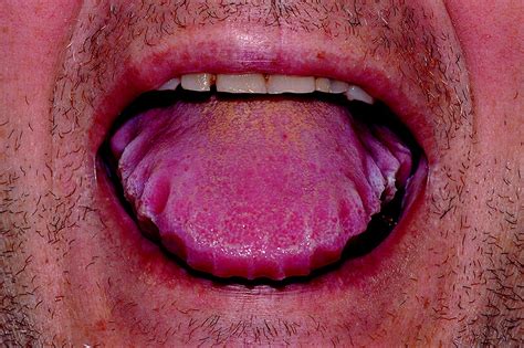 Tongue Amyloidosis