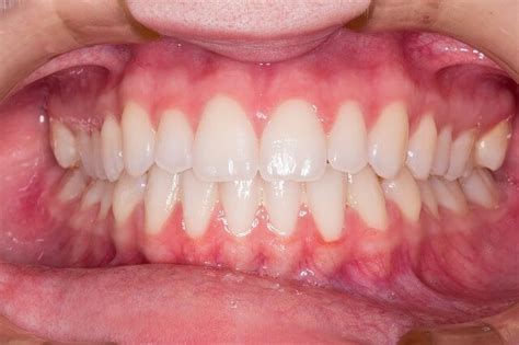 Bump On Gums Causes And Treatment 25 Doctors