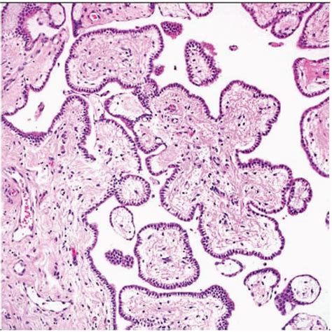 Peritoneal Mesothelioma Histology Pathology Outlines