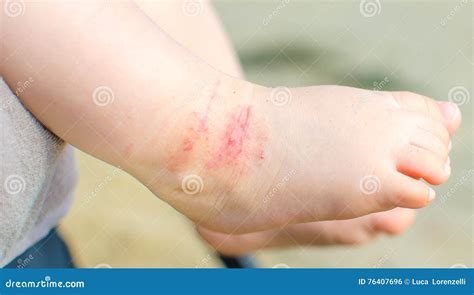 Pé Atópico Do Bebê Da Dermatite Sarnento Foto De Stock Imagem De Pés