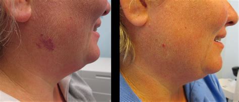 Birthmarks Southern Cosmetic Laser Charleston Botox And Skin Care
