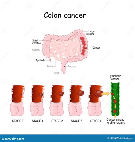 Colorectal Cancer Cartoon