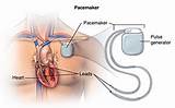 Recovery Time After Defibrillator Implant Pictures