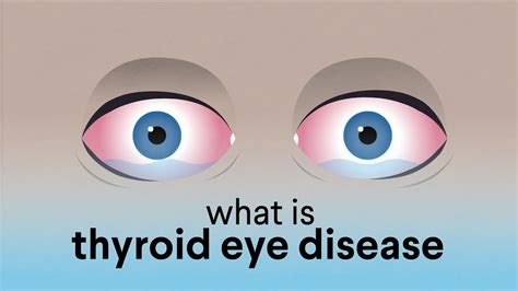 What Is Thyroid Eye Disease Ted Youtube