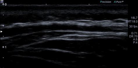 Color Doppler Ultrasound Of The Temporal Arteries Download Scientific