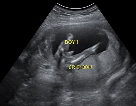 Gender Ultrasound Photos Babycenter