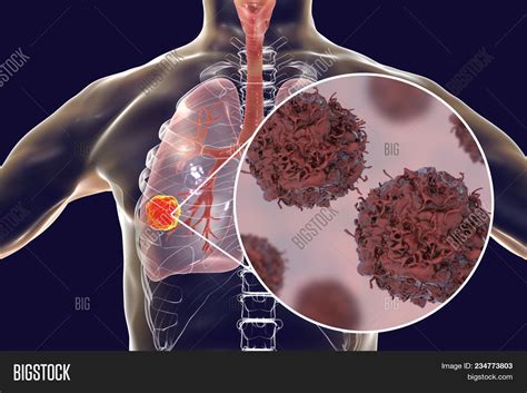 Lung Cancer Tumor Image And Photo Free Trial Bigstock