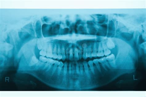 Closeup X Ray Of Impacted Wisdom Tooth Stock Photo Image Of Bone