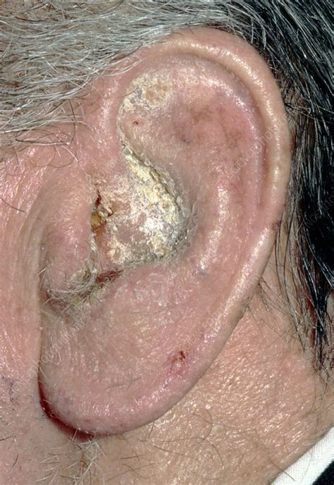 Otitis Externa Showing Infected Outer Ear Stock Image M1570031