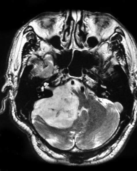 Epidermoid Cyst Of The Cerebellopontine Angle Radrounds Radiology