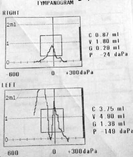 Tympanogram Showing Double Peak Admittance And Very Large Canal Volume