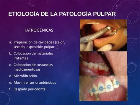 Diagnostico Pulpar Y Patología Pulpar