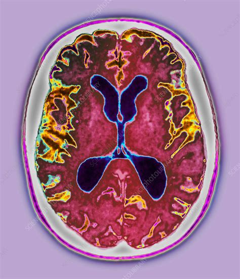 Alzheimers Disease Mri Scan Stock Image M1080687 Science Photo