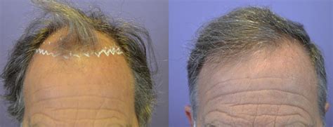 FUT Hairline Restoration On A 66 Year Old Male Norwood Class 5 Hair