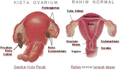 Apa Perbedaan Kista Ovarium Dan Endometriosis My Xxx Hot Girl