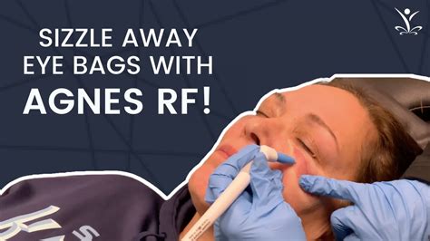 Sizzle Away Under Eye Bags With Agnes Rf Youtube