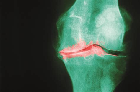 Osteoarthritis Pathophysiology And Diagnosis The Pharmaceutical Journal