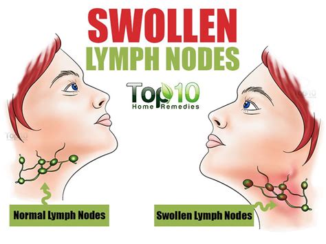 Causes include infection, inflammation, or cancer. Home Remedies for Swollen Lymph Nodes | Top 10 Home Remedies