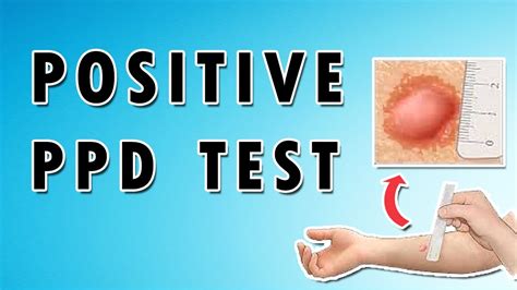 Positive Ppd Test Youtube