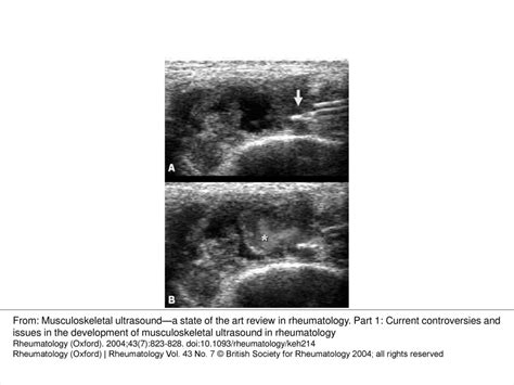 Fig 1 Sonographic Guided Injection Of Steroid In The