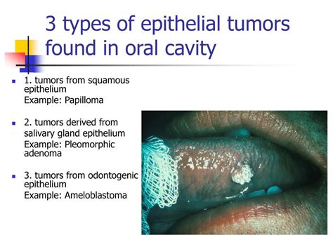 Ppt Neoplasia Powerpoint Presentation Free Download Id1384968