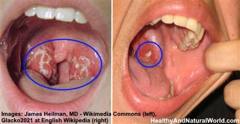 Rough Patch On Tonsils White Spots Fasrim