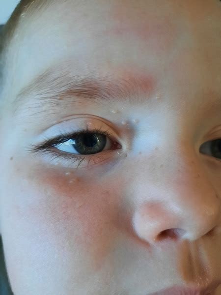 Pic Included What Are These Spots On 3yo Face Mumsnet