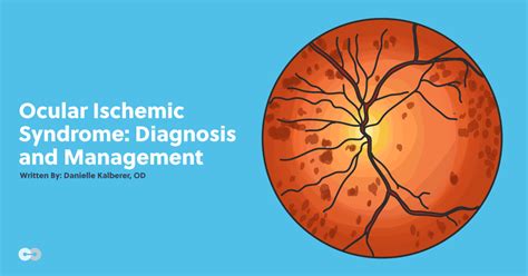 Ocular Ischemic Syndrome Diagnosis And Management