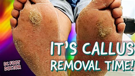 Its Callus Removal Time Trimming Multiple Thick Calluses Youtube