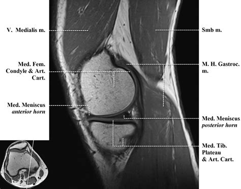 Normal Mr Imaging Anatomy Of The Knee Magnetic Resonance Imaging Clinics