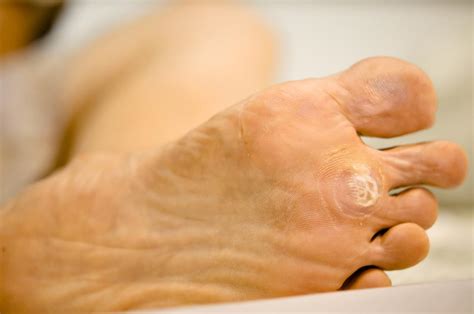 Plantar Warts Symptoms Causes And Treatment