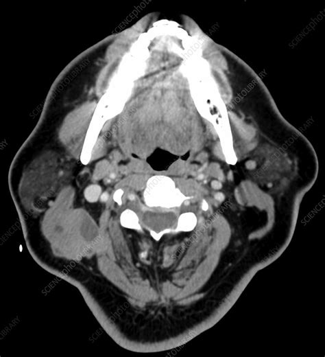 Metastatic Cervical Lymph Node Ct Scan Stock Image C0393528