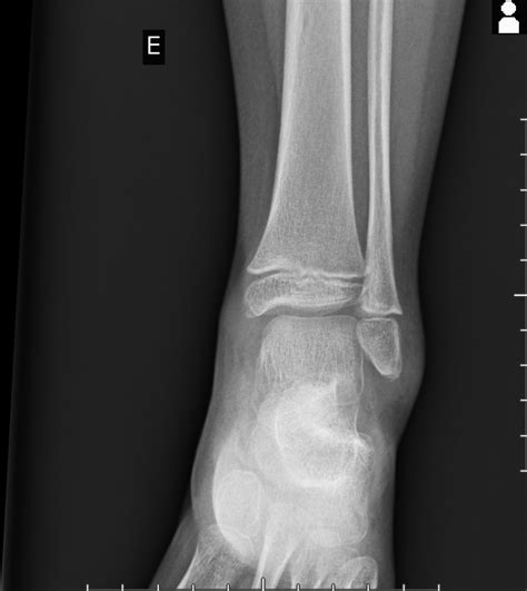 Salter Harris Type I Fracture Of Distal Fibula Image