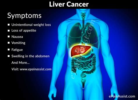 Liver Cancer Treatment Causes Symptoms Signs Prevention