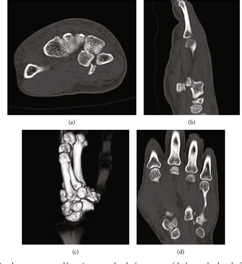 Figure 2 From Volar Dislocation Of The Fourth And Fifth Carpometacarpal