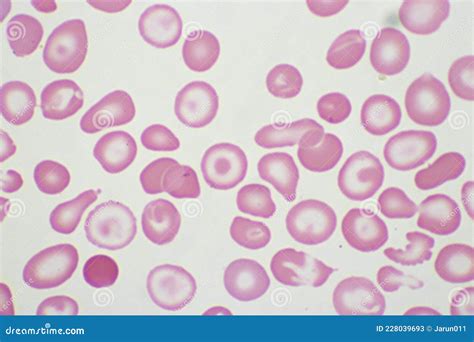 Target Cells With Abnormal Red Blood Cells In Blood Smear Stock Image