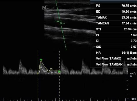 Ultrasound Image Of Common Carotid Doppler Waveform And Velocity Time