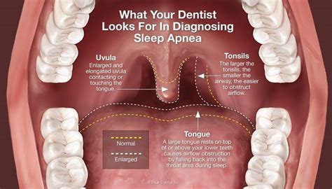 Sleep Apnea Benton And Nelson Dentistry Winston Salem Nc