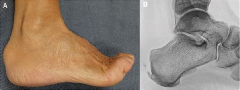 How To Treat Haglunds Deformity In Runners