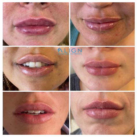 How Long Do Lips Hurt After Filler Lipstutorial Org
