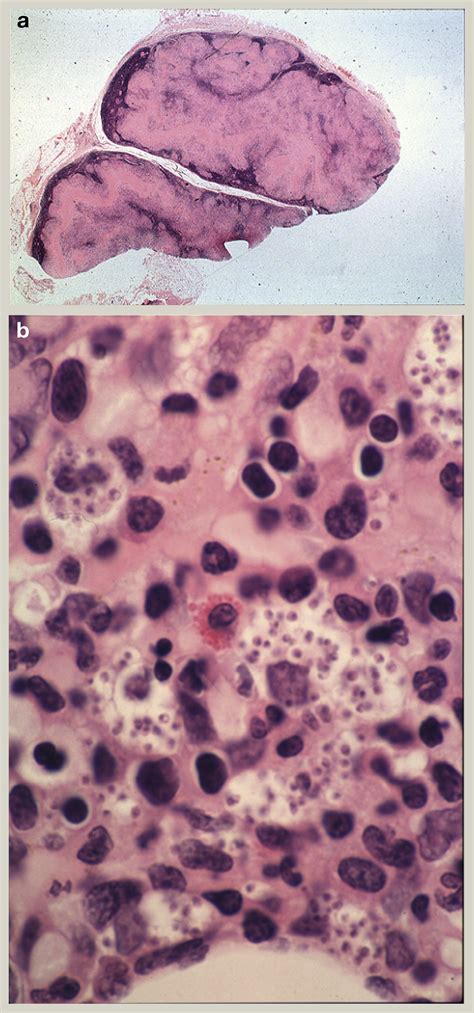 Lymph Node Pathology In Infectious Diseases Diagnostic Histopathology
