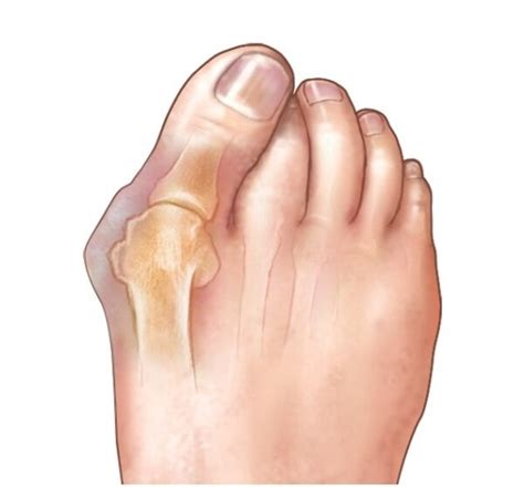 JUANETES: ¿Qué son?, tratamiento, causas y síntomas. - GuasApp